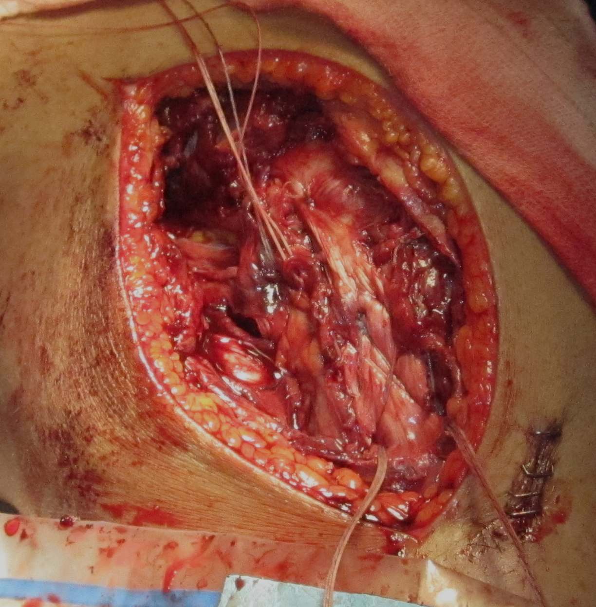 MCL Tibial Avulsion Double Row Repair